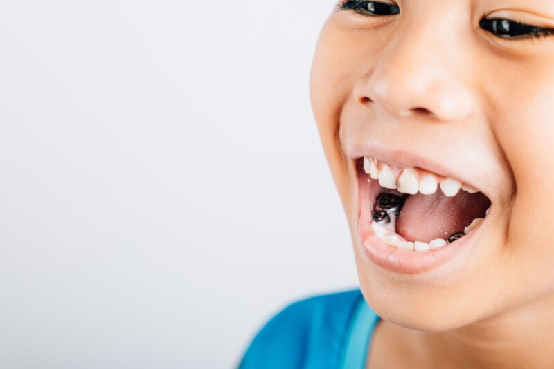 Sealants for Kids Pasco