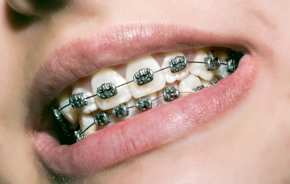 Traditional Braces for Kids Pasco